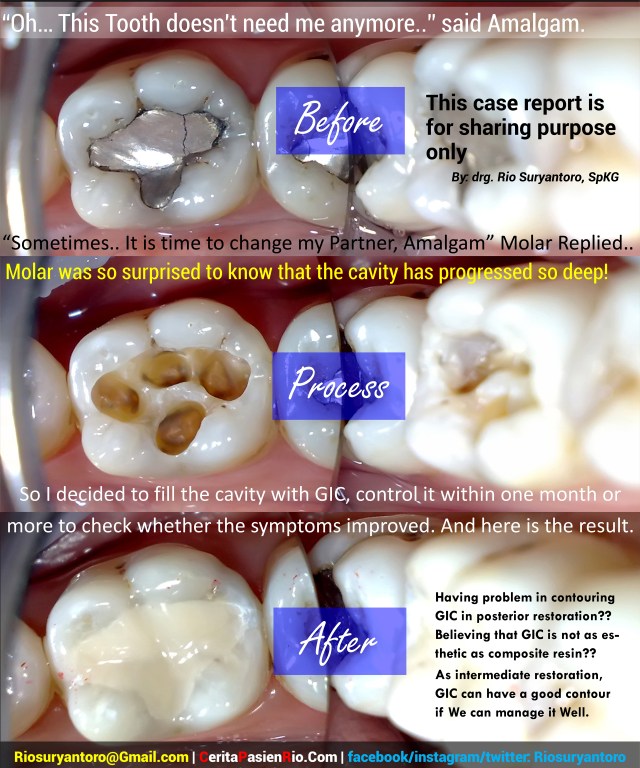 (2560 sq) hermna GIC dari amalgam part 2