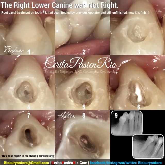 dokter gigi rio spesialis konservasi gigi jakarta indonesia perawatan saluran akar endodontic protaper 3m tambalan estetik kosmetik pulpa dentin email (15)