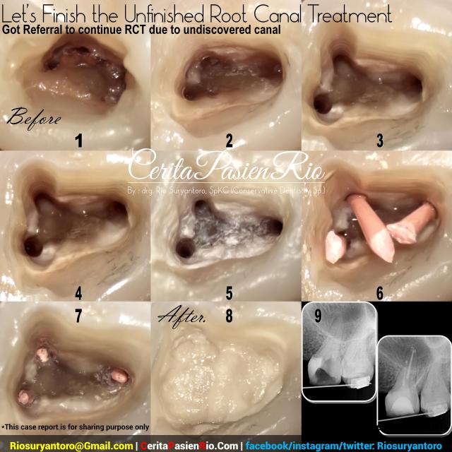 dokter gigi rio spesialis konservasi gigi jakarta indonesia perawatan saluran akar endodontic protaper 3m tambalan estetik kosmetik pulpa dentin email (16)