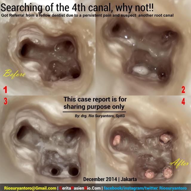 dokter gigi rio spesialis konservasi gigi jakarta indonesia perawatan saluran akar endodontic protaper 3m tambalan estetik kosmetik pulpa dentin email (7)