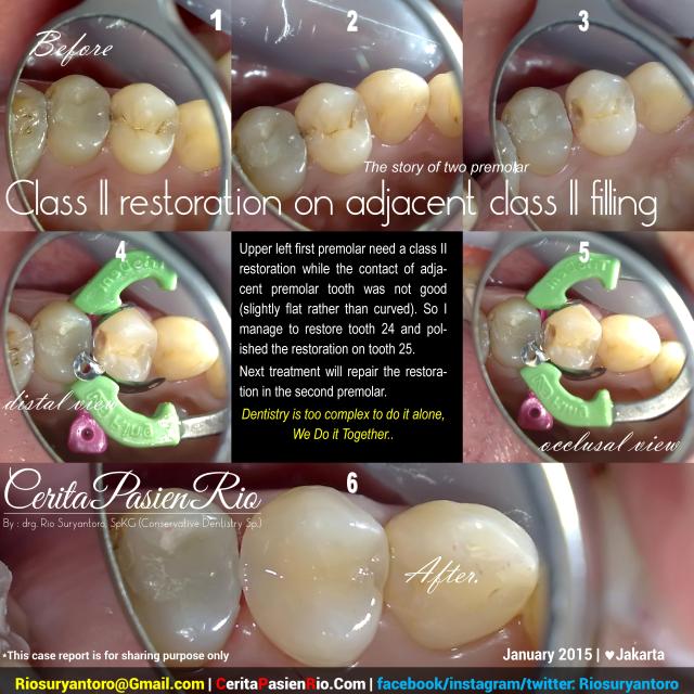 restoration of class 2 composite dokter gigi rio suryanto spesialis konservasi gigi asun tambalan estetik resin kompo