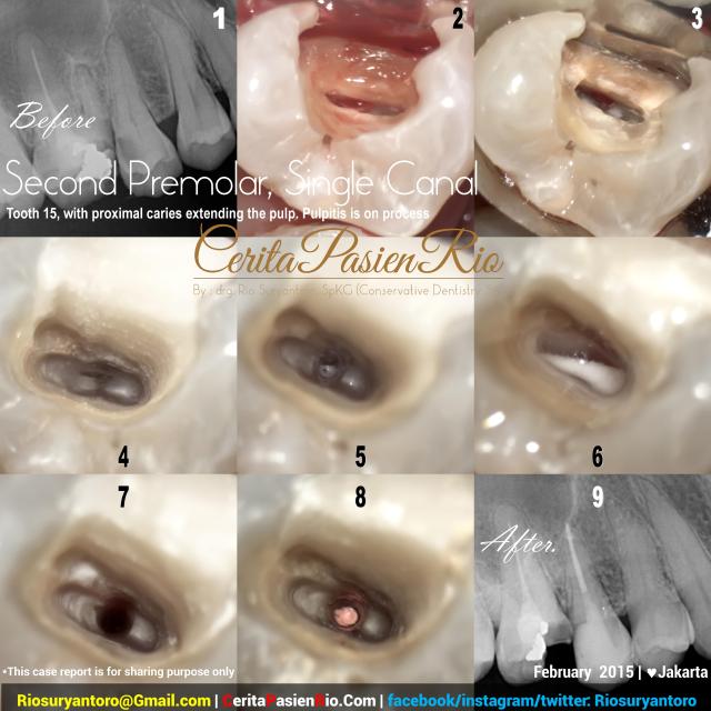 dokter gigi rio suryantoro spesialis konservasi gigi bu retno simple premolar root canal treatment