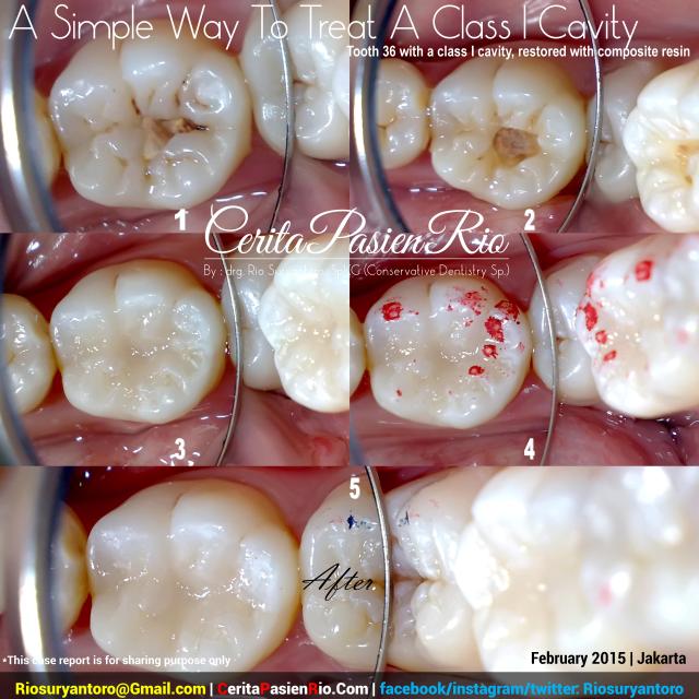 dokter gigi rio suryantoro spesialis konservasi gigi resin komposit kelas 1