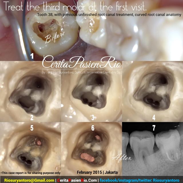 sapti psa 38 bengkok doker gigi rio suryantoro spesialis konservasi gigi perawatan saluran akar one visi