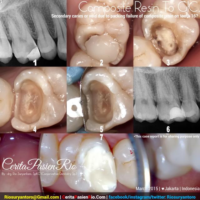 drg. Rio, SpKG resin komposit kelas 2 16 Tri maret 2015