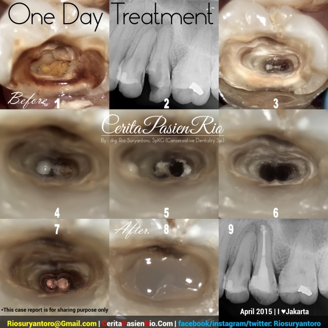 dokter gigi rio suryantoro spesialis konservasi gigi perawatan saluran akar