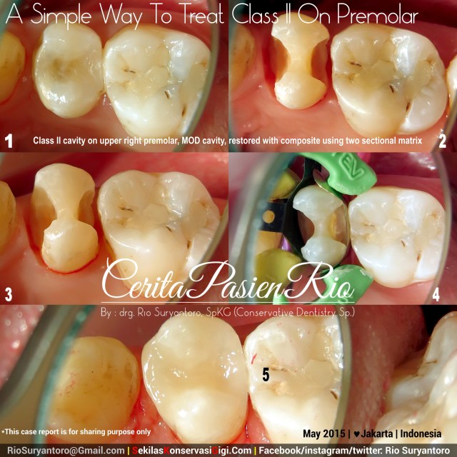 drg. Rio, SpKG resin komposit kelas 2 10 MEI 2015 spesialis konservasi gigi