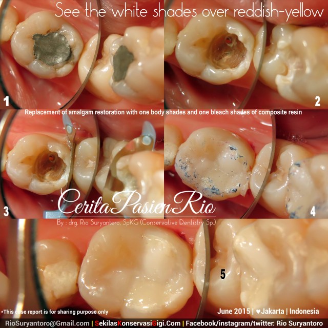 drg. Rio, SpKG resin komposit kelas 2drg fani 46 AF2 spesialis konservasi gigi