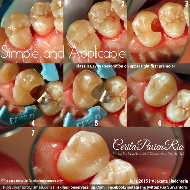 drg. Rio SpKG RK Mayapada gigi 14 kelas 2