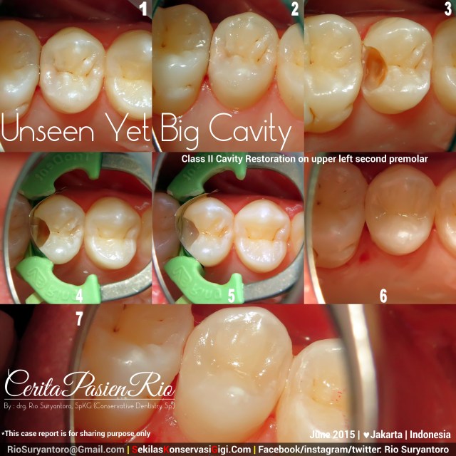 drg. Rio SpKG RK safira resin komposit kelas 2 9 juni 2015