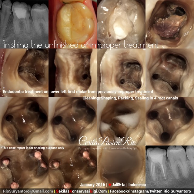 sakit gigi perawatan saluran akar PSA molar tambal gigi spesialis