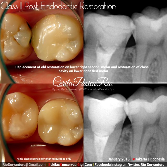 sakit gigi perawatan saluran akar penambalan karies gigi restodontic endodontic