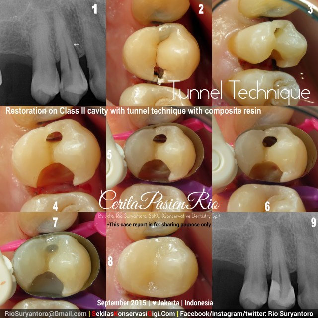 sakit gigi ke dokter gigi spesialis konservasi gigi jakarta lho