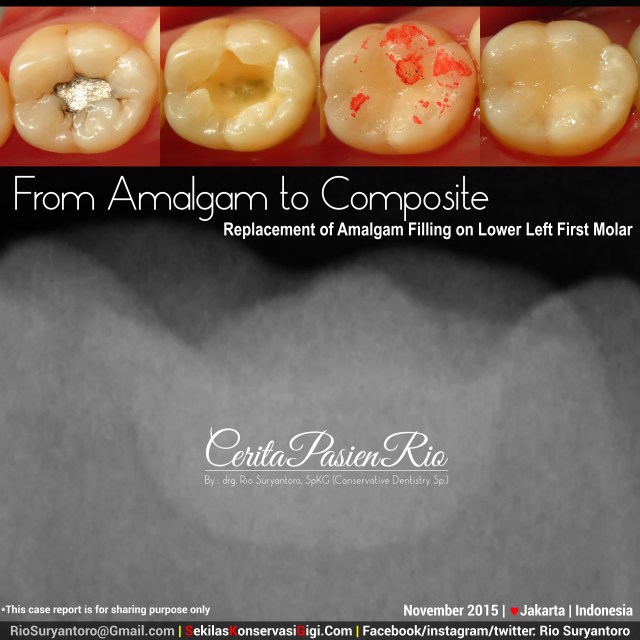 sakit gigi ke dokter gigi spesialis konservasi gigi perawatan saluran akar gigi tambal gigi