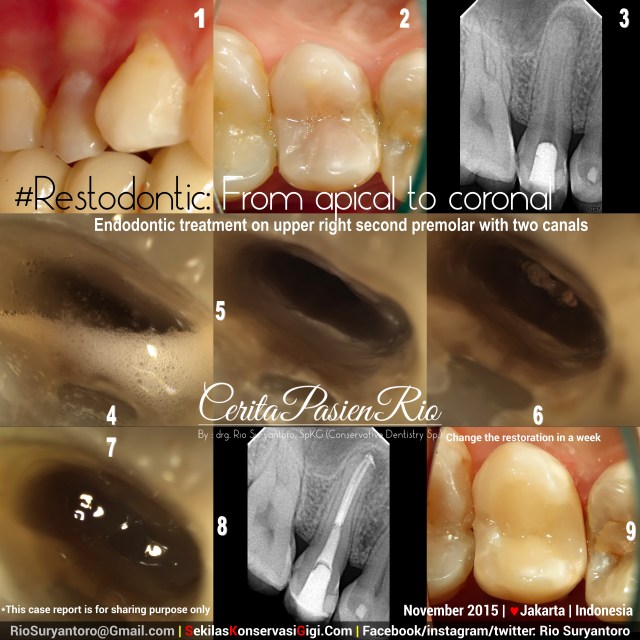 dokter gigi spesialis konservasi gigi jakarta tambal gigi perawatan akar gigi
