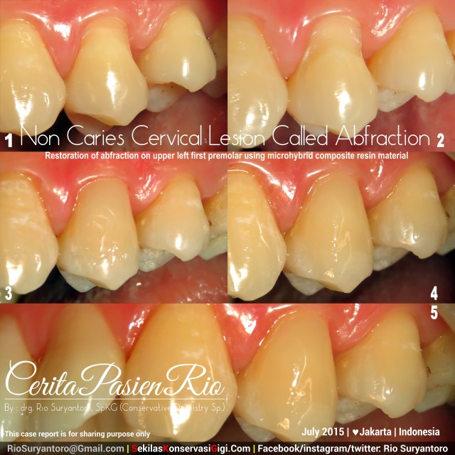 drg. Rio, SpKG resin komposit Junaedi abfraksi spesialis konservasi gigi