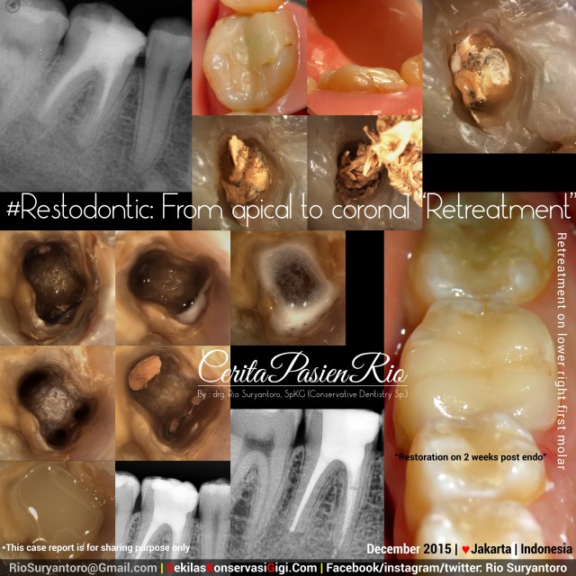 drg. Rio SpKG restodontic Rima 46 retreatment PSdesember 15