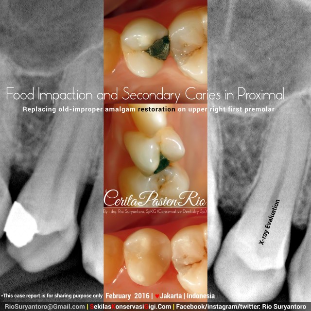 sakit gigi perawatan saluran akar resin komposit