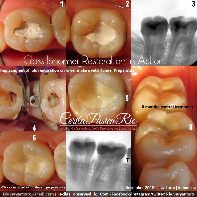 perawatan saluran akar tambalan gigi spesialis konservasi gigi dokter gigi jakarta
