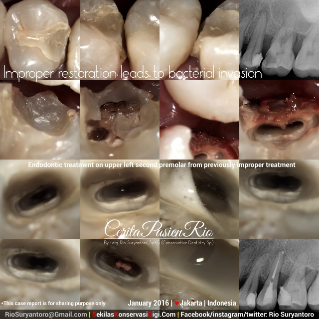sakit gigi dokter gigi spesialis konservasi gigi jakarta perawatan saluran akar