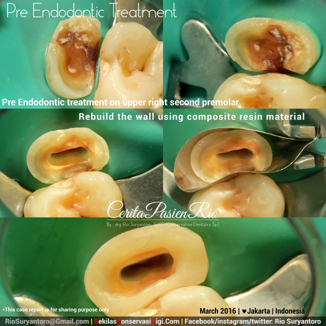 dokter gigi rio suryantoro spesialis konservasi gigi 15 all care pondok indah mengobati sakit gigi anda perawatan saluran akar