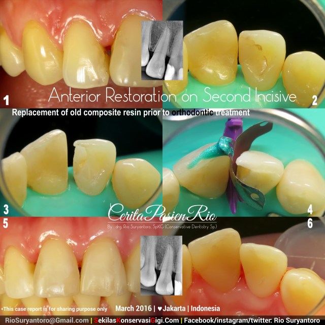 drg. Rio, SpKG yem kelas 4 slipi bulkfill dokter gigi spesialis konservasi gigi di  jakarta indonesia
