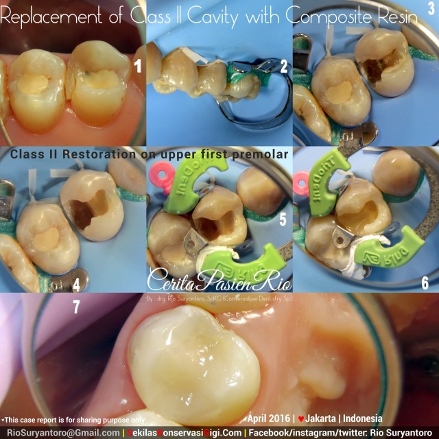 dokter gigi rio spesialis konservasi gigi jakarta gigi geraham PULP CAPPING estetika april