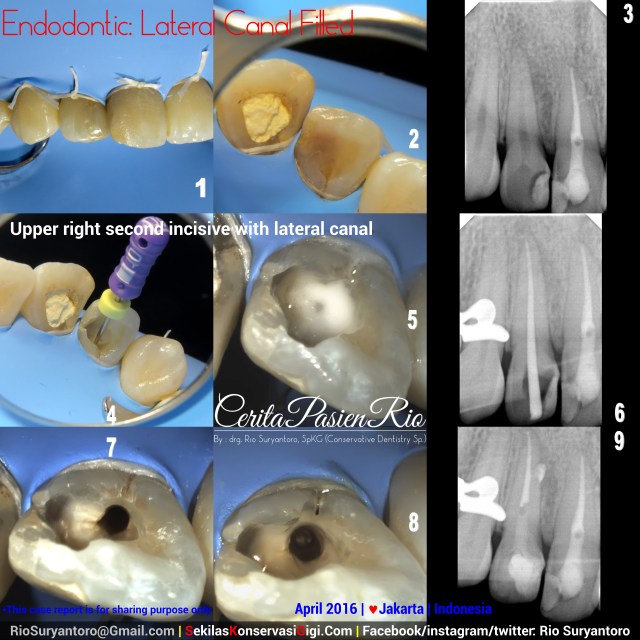 dokter gigi rio suryantoro spesialis konservasi gigi jakarta april mel slipi terbaik anterior