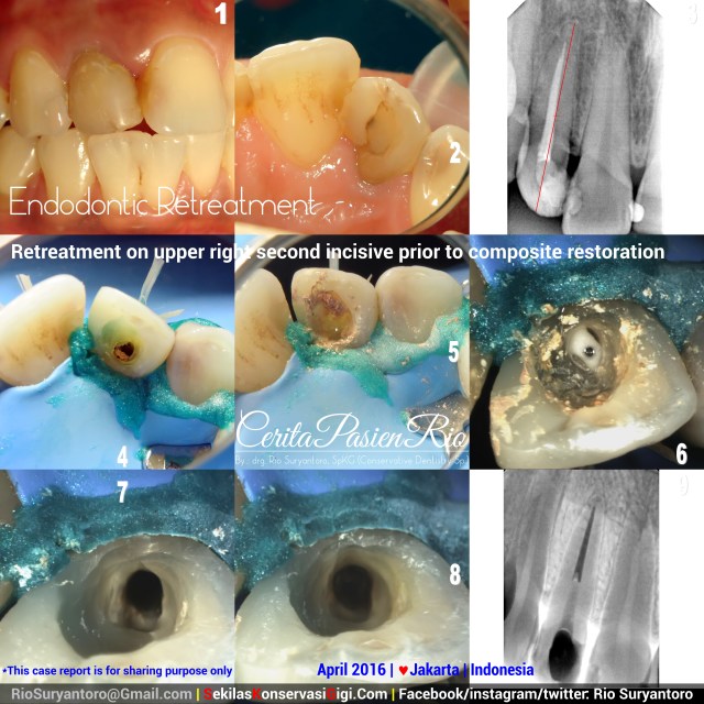 dokter gigi rio suryantoro spesialis konservasi gigi jakarta dessy april gigi anterior