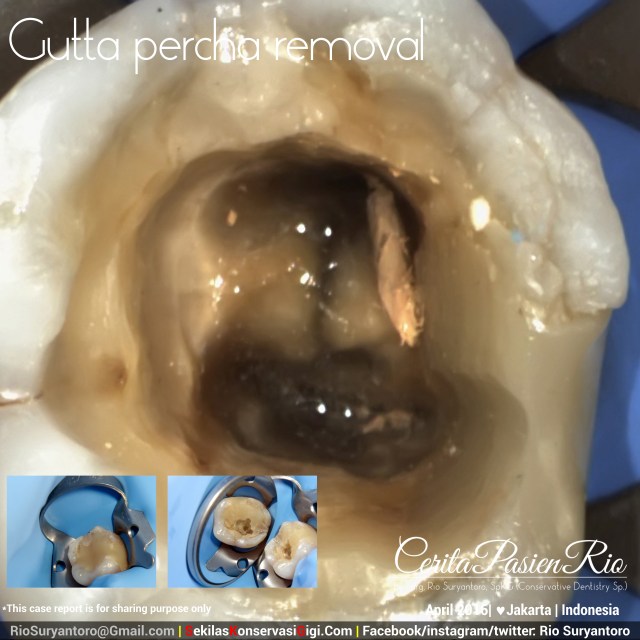 dokter gigi rio suryantoro spesialis konservasi gigi jakarta guttap removal