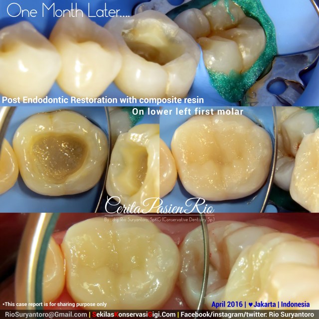 dokter gigi rio suryantoro spesialis konservasi gigi tambalan pasca perawatan saluran akar