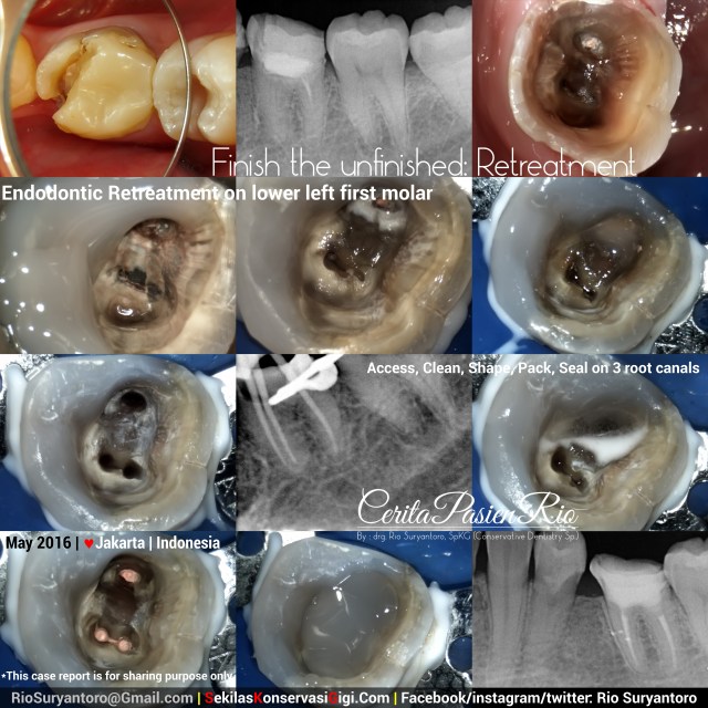 dokter gigi rio spesialis konservasi gigi dentsply 3m filtek bulkfill protaper next mei2016 ari