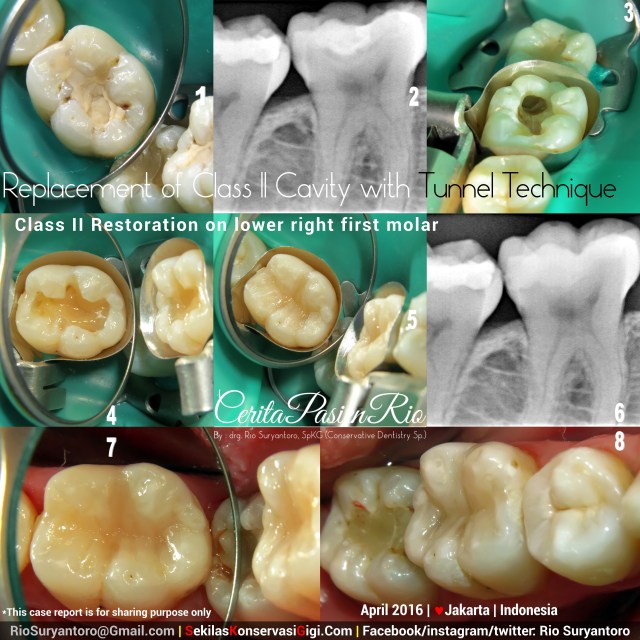dokter gigi rio spesialis konservasi gigi jakarta gigi geraham TUNNEL TECHNIQUE SLIPI april