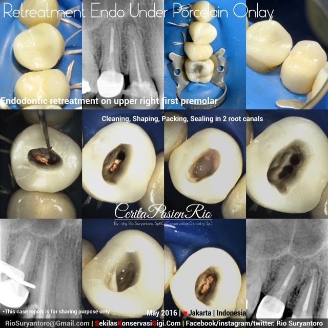 dokter gigi rio spesialis konservasi gigi terbaik jakarta indonesia mei emax onlay failed ok