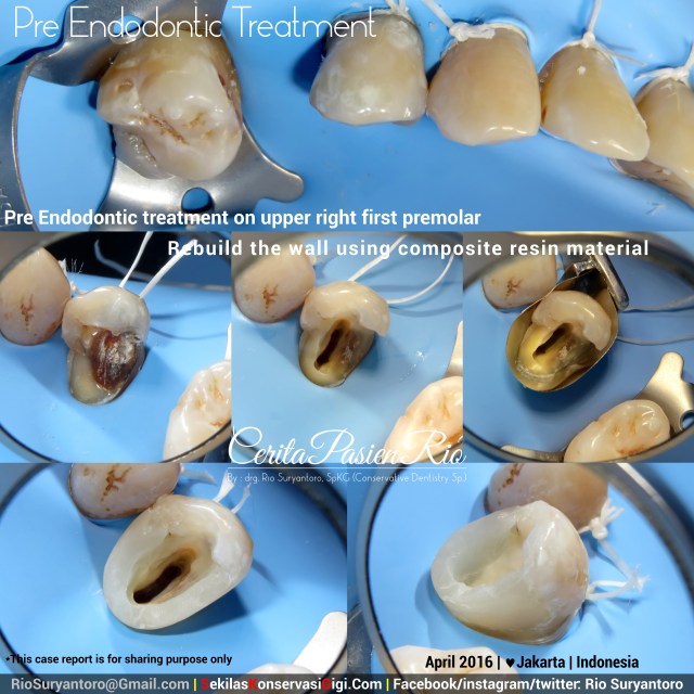 dokter gigi rio suryantoro spesialis konservasi gigi 14 slipi safrud rebuild the wall