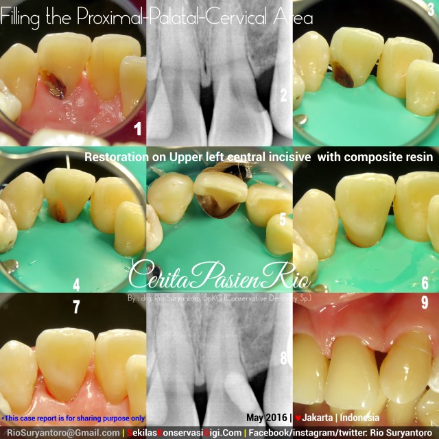 dokter gigi rio suryantoro spesialis konservasi gigi jakarta mei novi slipi anterior 21