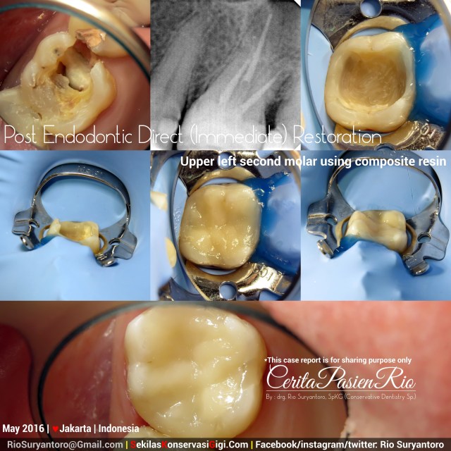 dokter gigi rio suryantoro spesialis konservasi gigi terbaik jakarta Evi mei Estet