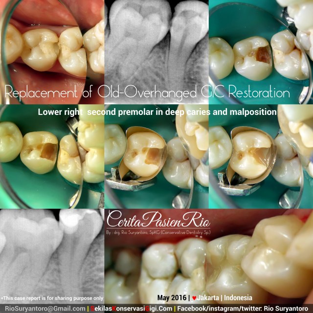 dokter gigi rio suryantoro spesialis konservasi gigi terbaik jakarta NS 45mei slipi