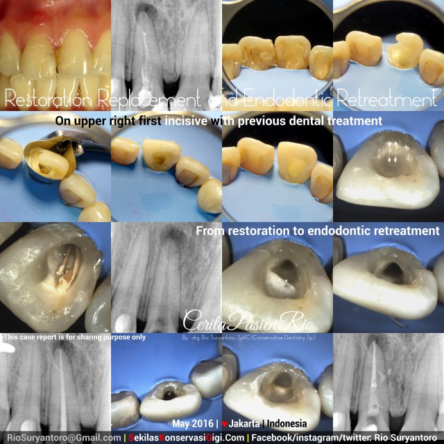 dokter gigi rio suryantoro spesialis konservasi jakarta perawatan endo incisive 1 retreatment slipi