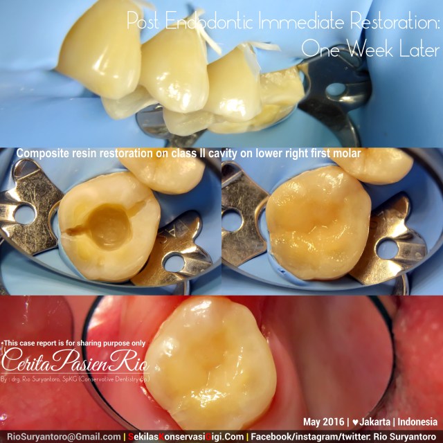 dokter gigi rio suryantoro spesialis konservasi jakarta perawatan endo molar 2 stef slipi terbaik pasca PSA