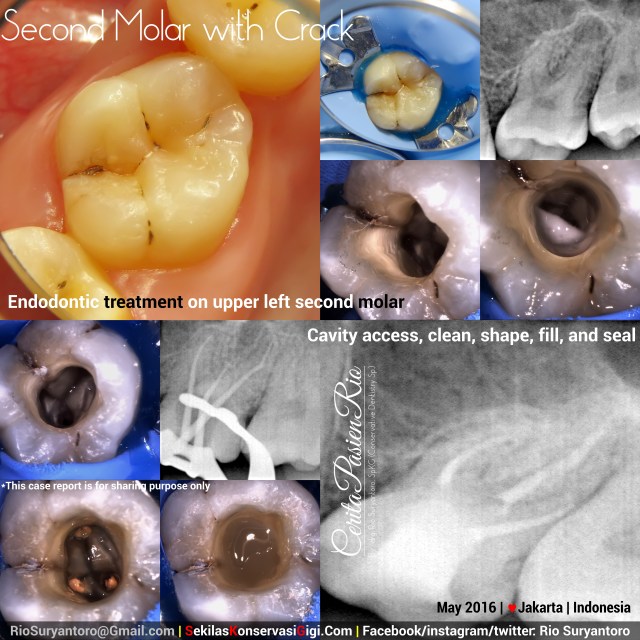 dokter gigi rio suryantoro spesialis konservasi jakarta perawatan endo molar 2 stef slipi terbaik