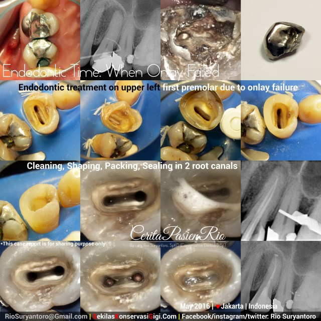 dokter gigi rio suryantoro spesialis konservasi jakarta perawatan endo PREMOLAR 1 Syaf mypdmei 16