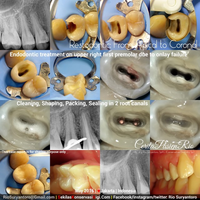 dokter gigi rio suryantoro spesialis konservasi jakarta perawatan endo PREMOLAR 1 TARA mypdmei 16