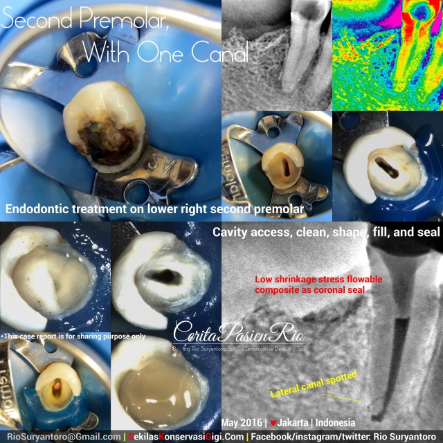 fig 1. Previous endodontic procedure. 