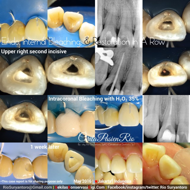 spesialis konservasi jakarta perawatan endo incisive 2 treatment PI