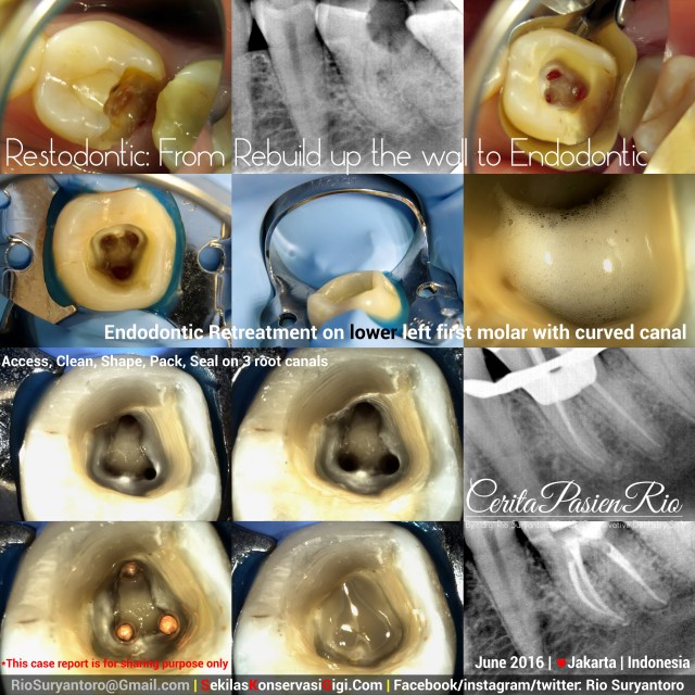 dokter gigi rio suryantoro spesialis konservasi gigi terbaik jakarta endodontik 36 est mur Juni