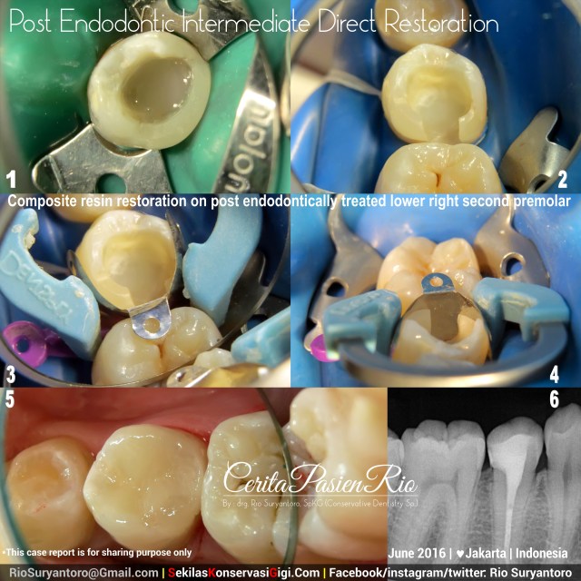 fig 2. restorative procedure.