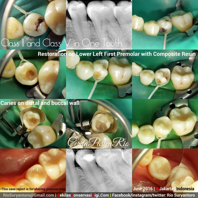 dokter gigi rio suryantoro spesialis konservasi gigi terbaik jakarta tambal resin komposit 35 jun lulu