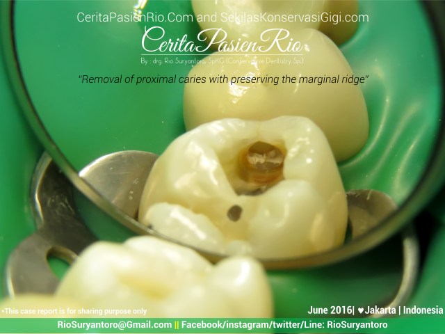 dokter gigi rio suryantoro spesialis konservasi gigi jakarta relax tunnel jun