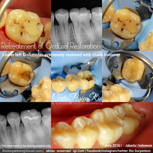 dokter gigi rio suryantoro spesialis konservasi gigi terbaik jakarta gracie mypd jun